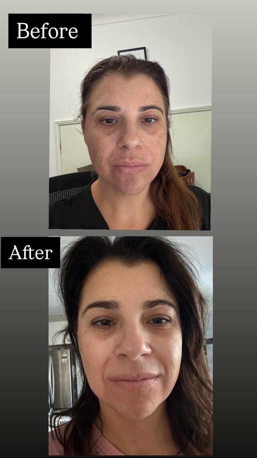 Pigmentation Result Before After